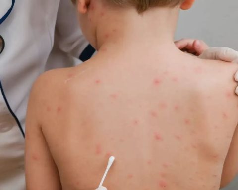 Escuelas de Coahuila alertan por un incremento de casos de varicela
