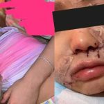 Samadhi, niña atacada por un perro en Torreón.
